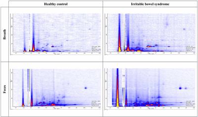 Volatile <mark class="highlighted">organic compound</mark> profiling as a potential biomarker in irritable bowel syndrome: A feasibility study